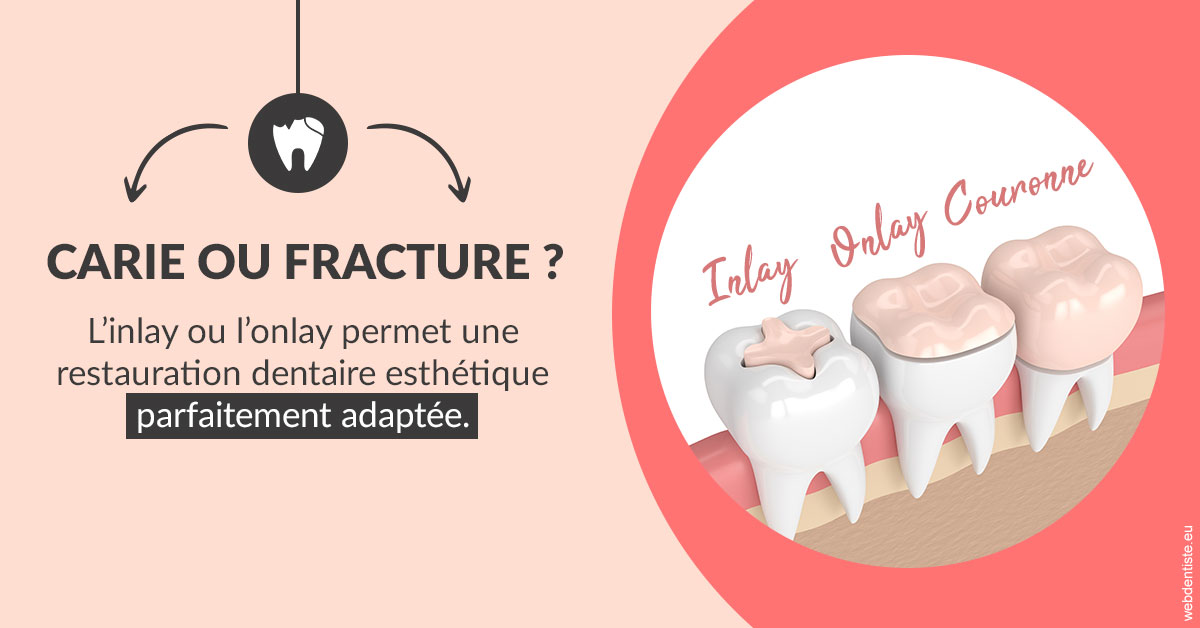 https://selarl-du-docteur-franck-wolff.chirurgiens-dentistes.fr/T2 2023 - Carie ou fracture 2