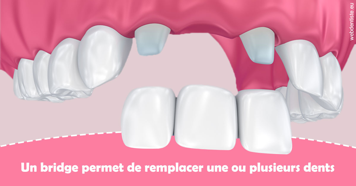 https://selarl-du-docteur-franck-wolff.chirurgiens-dentistes.fr/Bridge remplacer dents 2