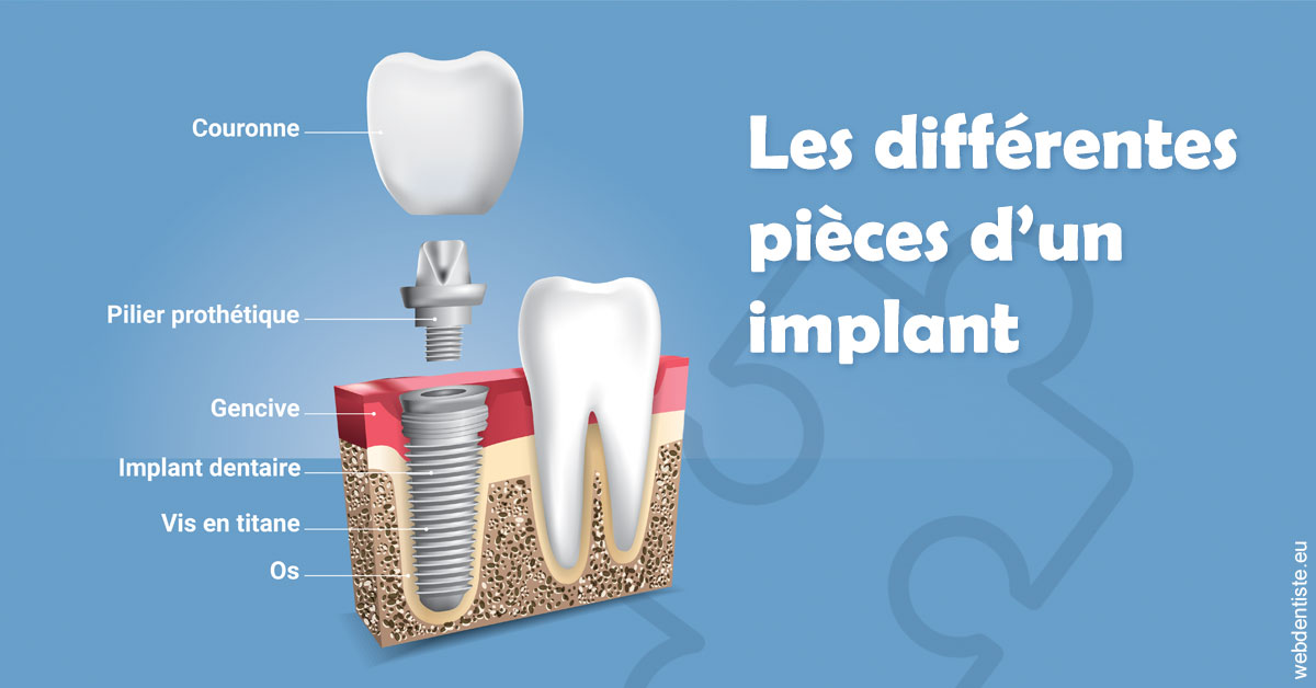https://selarl-du-docteur-franck-wolff.chirurgiens-dentistes.fr/Les différentes pièces d’un implant 1